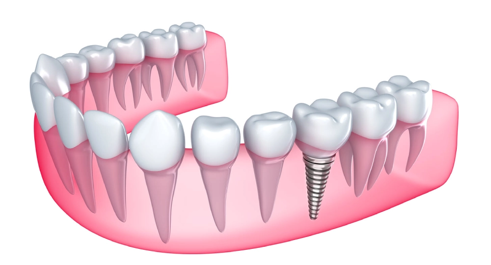 عيوب زراعة الأسنان | عيب التكامل الضعيف