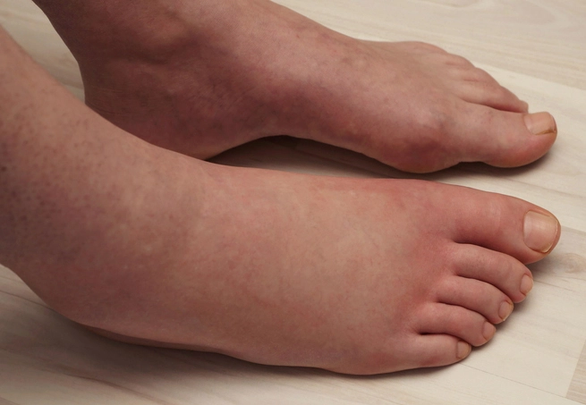 أمراض الكلى من أسباب تورم القدمين عند النساء