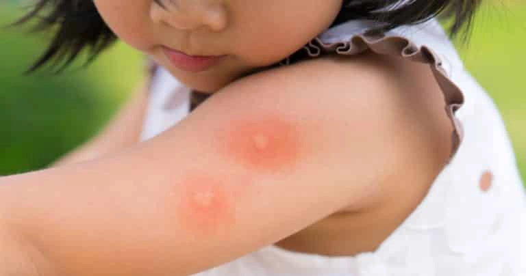 اعراض الحمى الفيروسية النزفية عند الأطفال