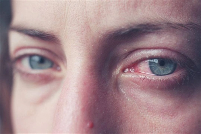 أعراض التهاب العين الفيروسي