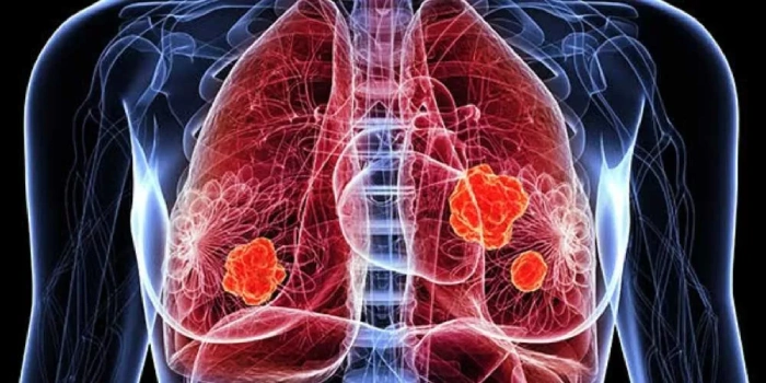 أعراض سرطان الرئة المبكرة