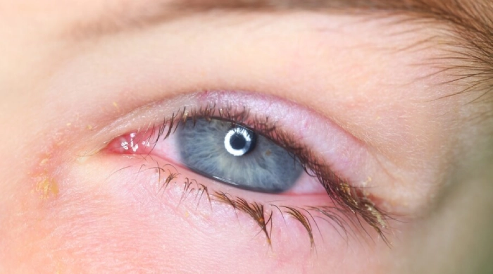 أنواع التهاب العين الفيروسي