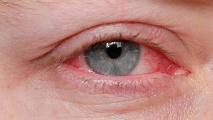 أمراض العين الخطيرة | التهاب العصب البصري