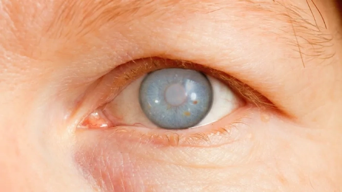 أمراض العين الخطيرة | الجلوكوما أو الزّرَق أو المياه الزرقاء