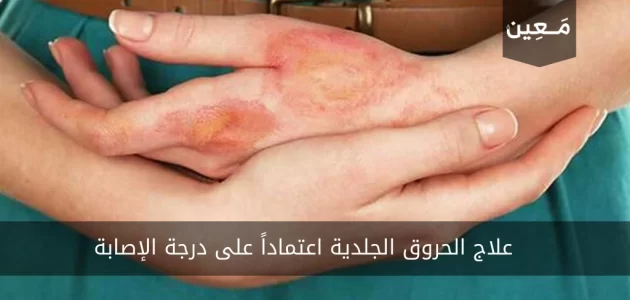 علاج الحروق الجلدية اعتماداً على درجة الإصابة