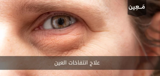 علاج انتفاخات العين | تدابير دوائية و طبيعية كفيلة باسترجاع جمال عينيك