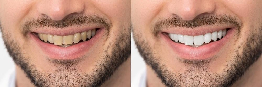 اسباب اصفرار الاسنان | العناية الصحيحة واختيار المنتجات المناسبة