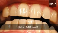 شاهد اسباب اصفرار الاسنان مع طرق العلاج