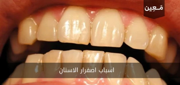 شاهد اسباب اصفرار الاسنان مع طرق العلاج