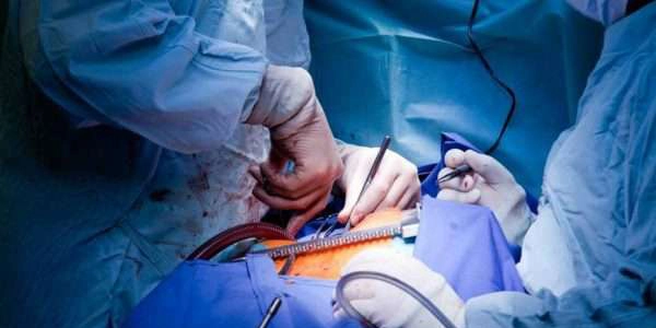 علاج الناسور العصصي من خلال الجراحة