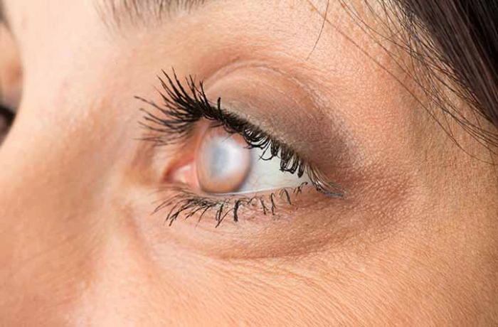 اعراض مرض اعتام عدسة العين