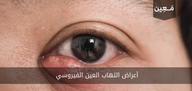 أعراض التهاب العين الفيروسي | و ما هي الحالات التي تستدعي مراجعة الطبيب