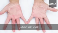 التهاب الجلد التماسي | و طريقة العلاج المناسبة