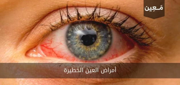 أمراض العين الخطيرة | أبرز 6 أمراض يجب معرفتها