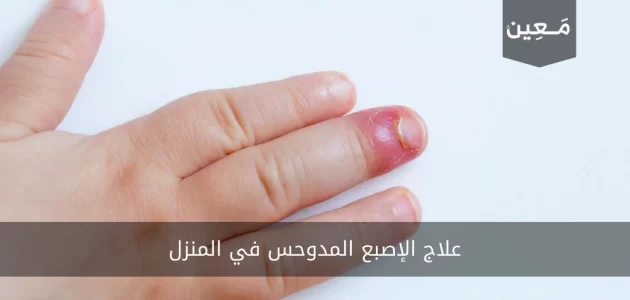 علاج الإصبع المدوحس في المنزل بطرق مجربة